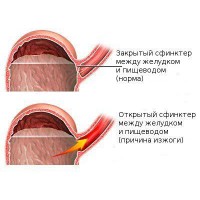 Две позиции на сърдечния сфинктер