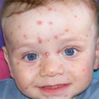 Симптоми на стафилокок ауреус върху кожата на бебето