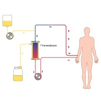 Фигурата показва как работи плазмаферезата