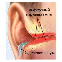 Симптоми на дифузен външен отит на средното ухо