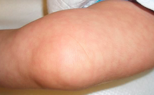 Мраморна кожа върху крака на детето