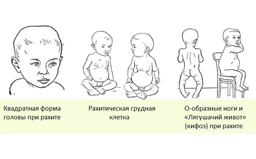 Схемата демонстрира симптомите на рахит при децата