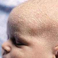 Кръстове на себореен дерматит върху главата на бебето