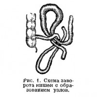Схемата на кривина на червата с образуването на възли