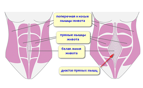 На фигурата диастазата на ректусите на коремните мускули (вдясно)