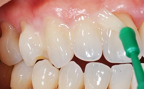 Флуоризация на зъби за кърмачета