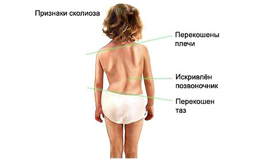 Фигурата с дете показва признаци на сколиоза