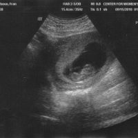 Десетседмичен фетус в ултразвуковата картина