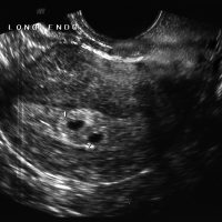 Ултразвукът ще покаже ембриона