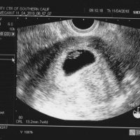 Седемседмичен ембрион в черно и бяло