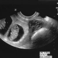 Деветседмичен ембрион в снимката на ултразвук