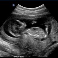 Ембрион с размерите на круша