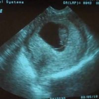 Ембрион в снимката на ултразвук