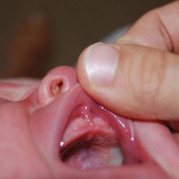 Лекарят отваря устата на бебето, за да покаже юздата на горната устна